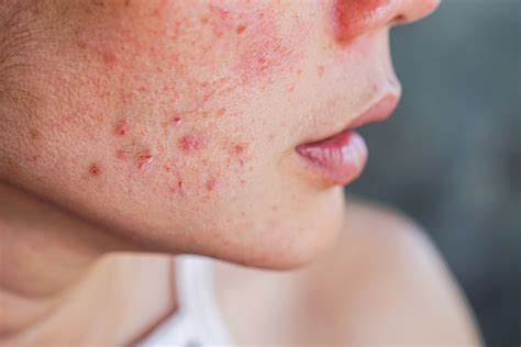 Otherwise, definitely talk to your clinician because ADHD drugs are not equivalent. . How to stop acne caused by adderall